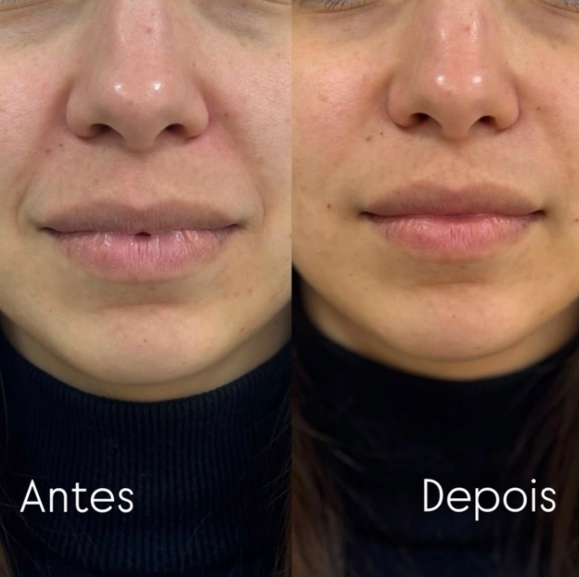 Resultado de tratamento facial antes e depois
